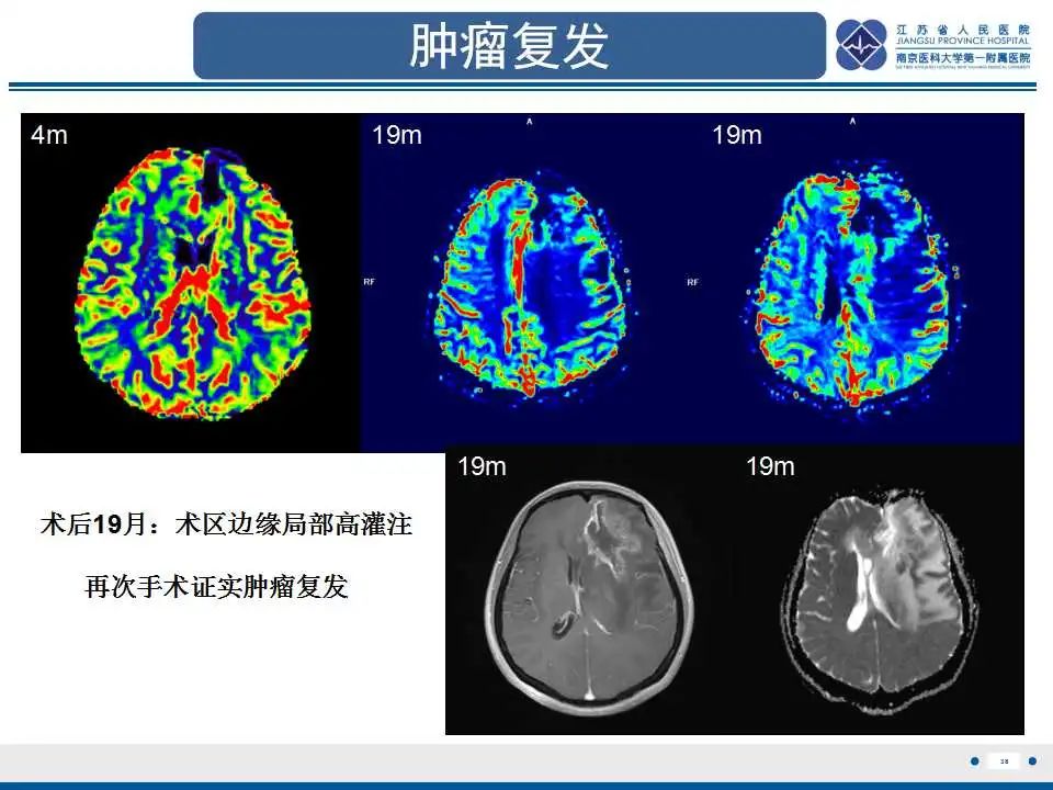 影像PPT - 【PPT】胶质瘤治疗后假性进展-39