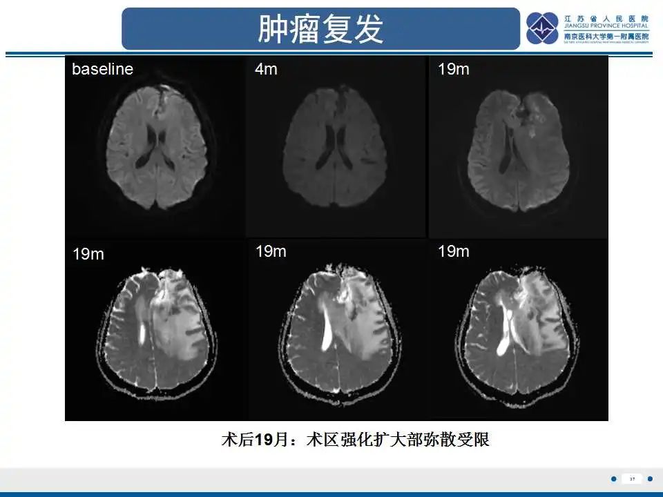 影像PPT - 【PPT】胶质瘤治疗后假性进展-38