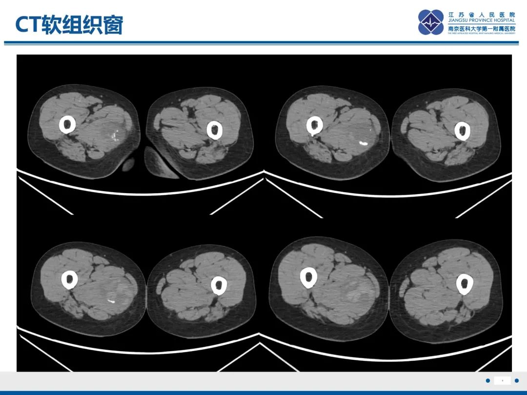 影像PPT - 【PPT】滑膜肉瘤-9