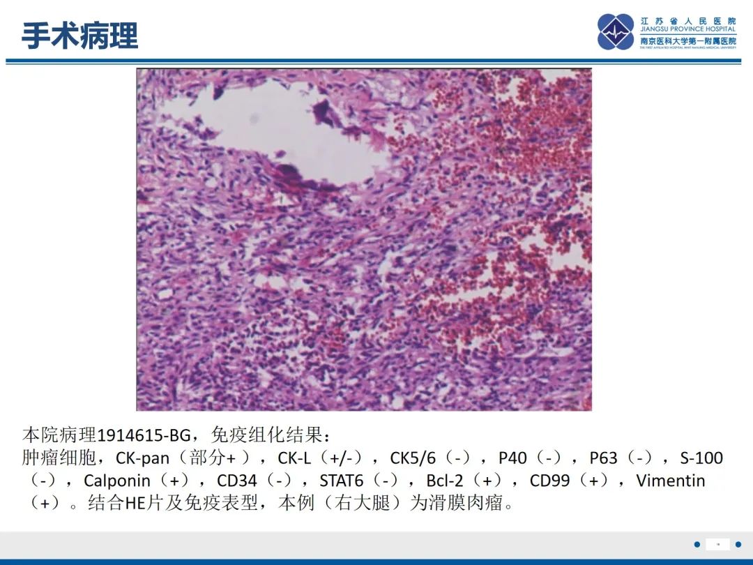 影像PPT - 【PPT】滑膜肉瘤-16