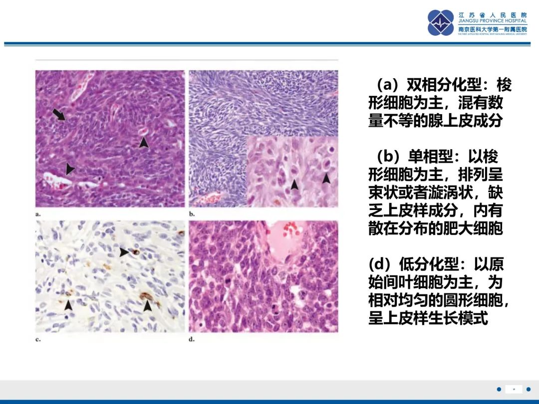 影像PPT - 【PPT】滑膜肉瘤-25