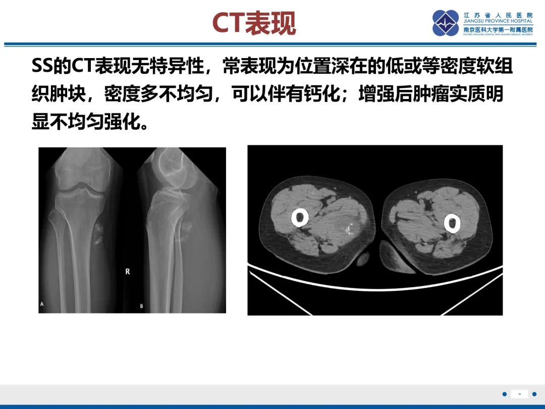 影像PPT - 【PPT】滑膜肉瘤-26