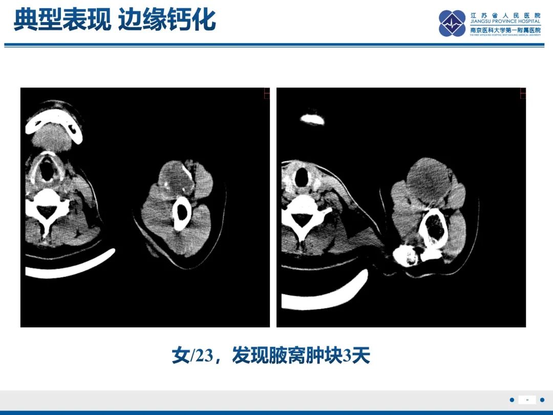影像PPT - 【PPT】滑膜肉瘤-29
