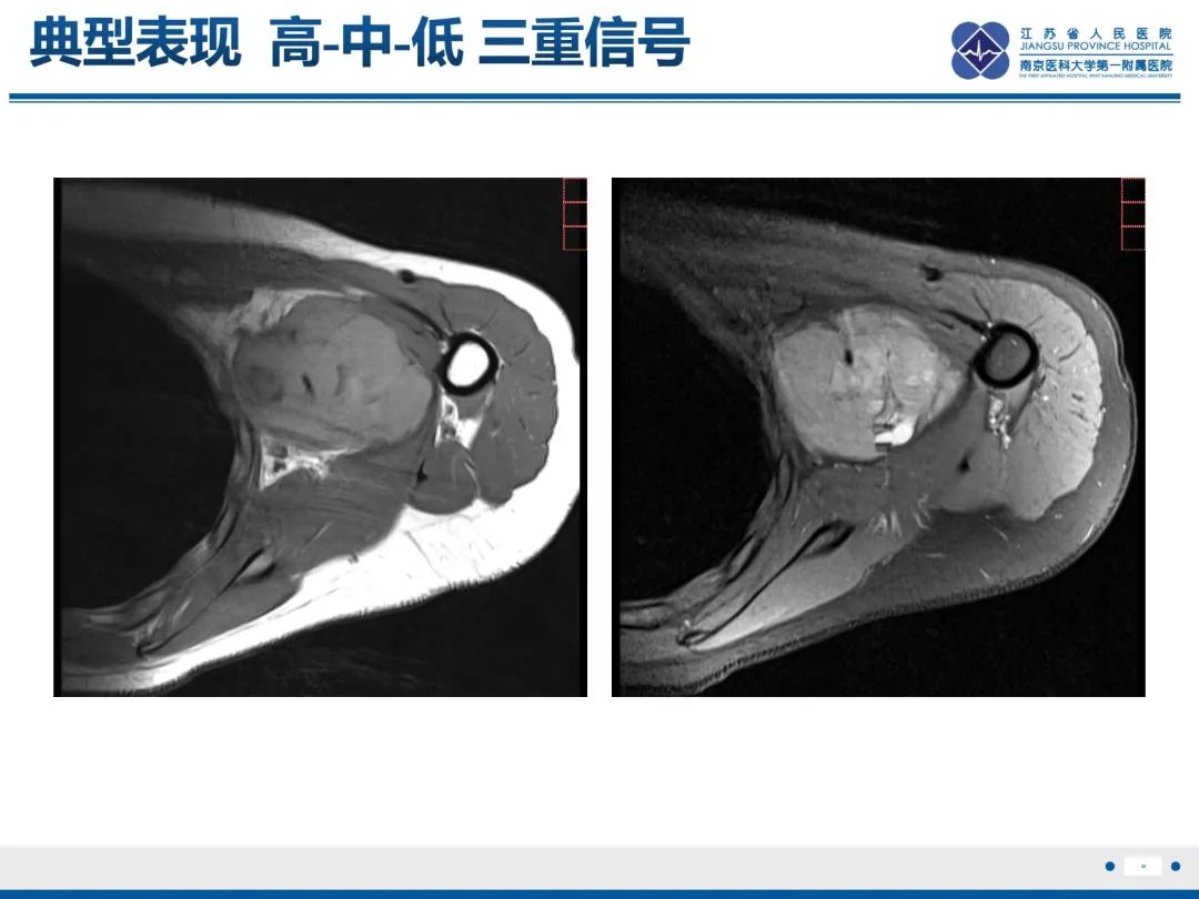 影像PPT - 【PPT】滑膜肉瘤-30