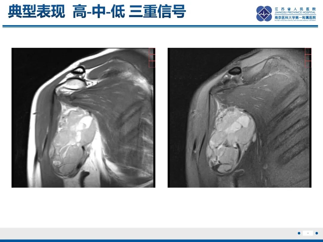 影像PPT - 【PPT】滑膜肉瘤-31