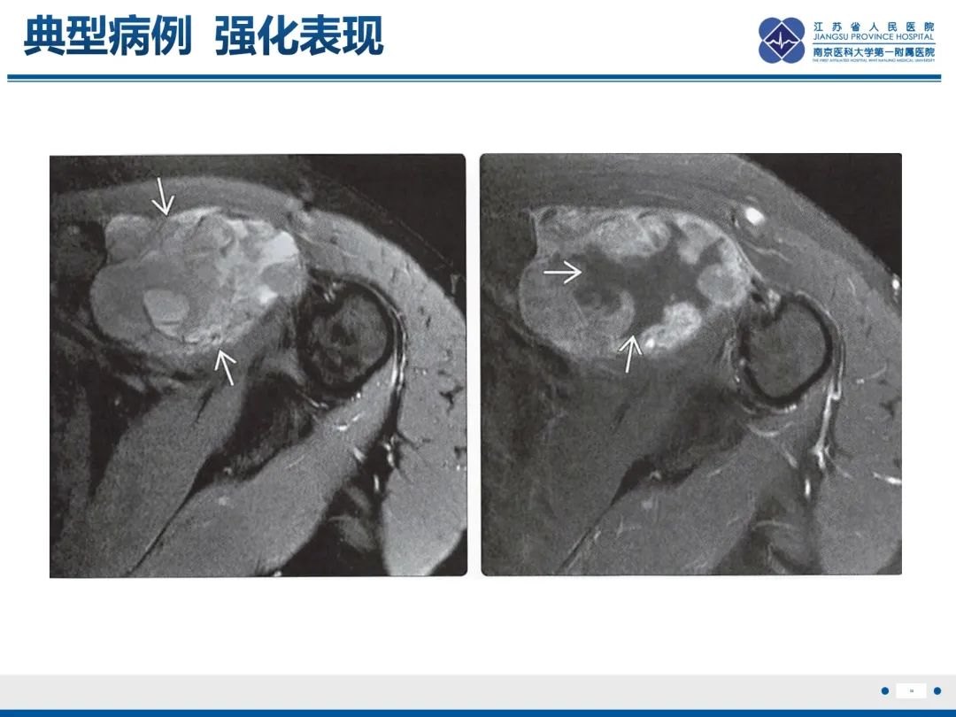 影像PPT - 【PPT】滑膜肉瘤-32