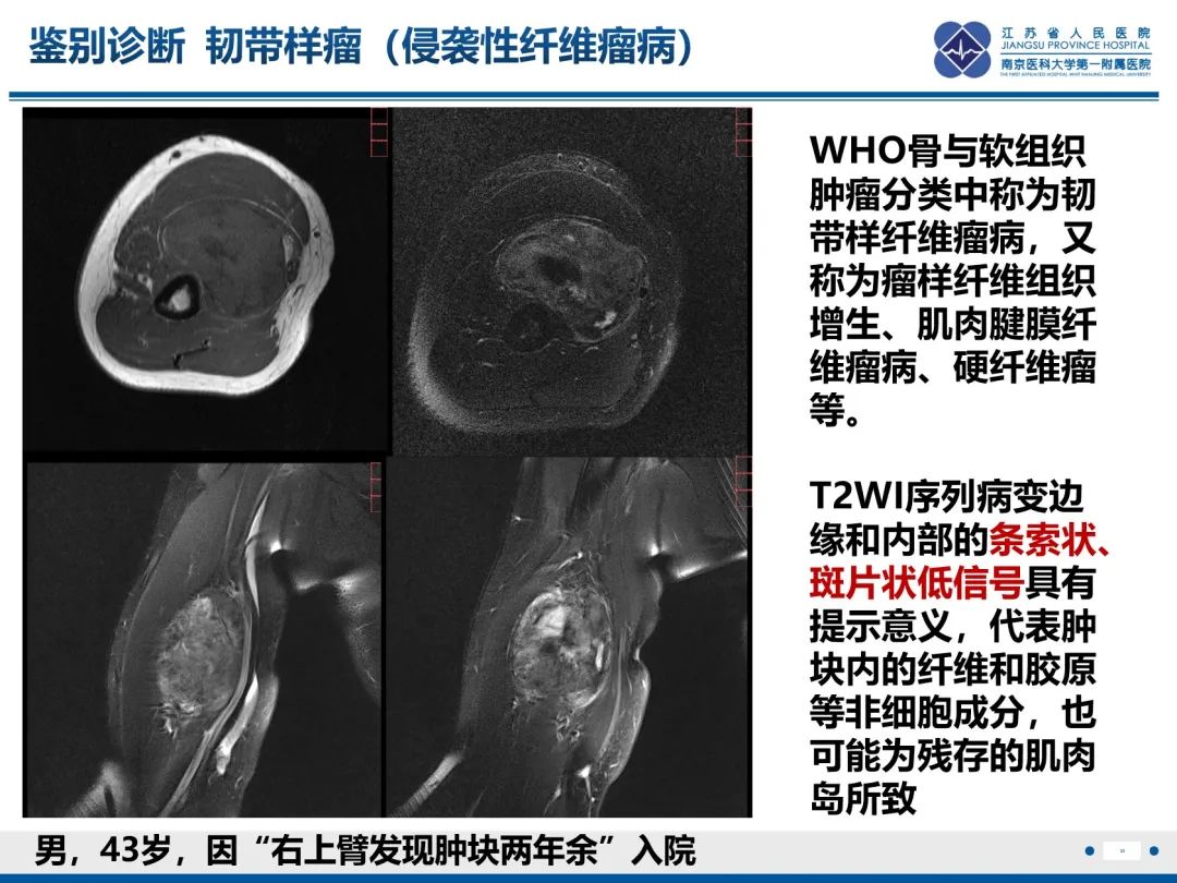 影像PPT - 【PPT】滑膜肉瘤-33