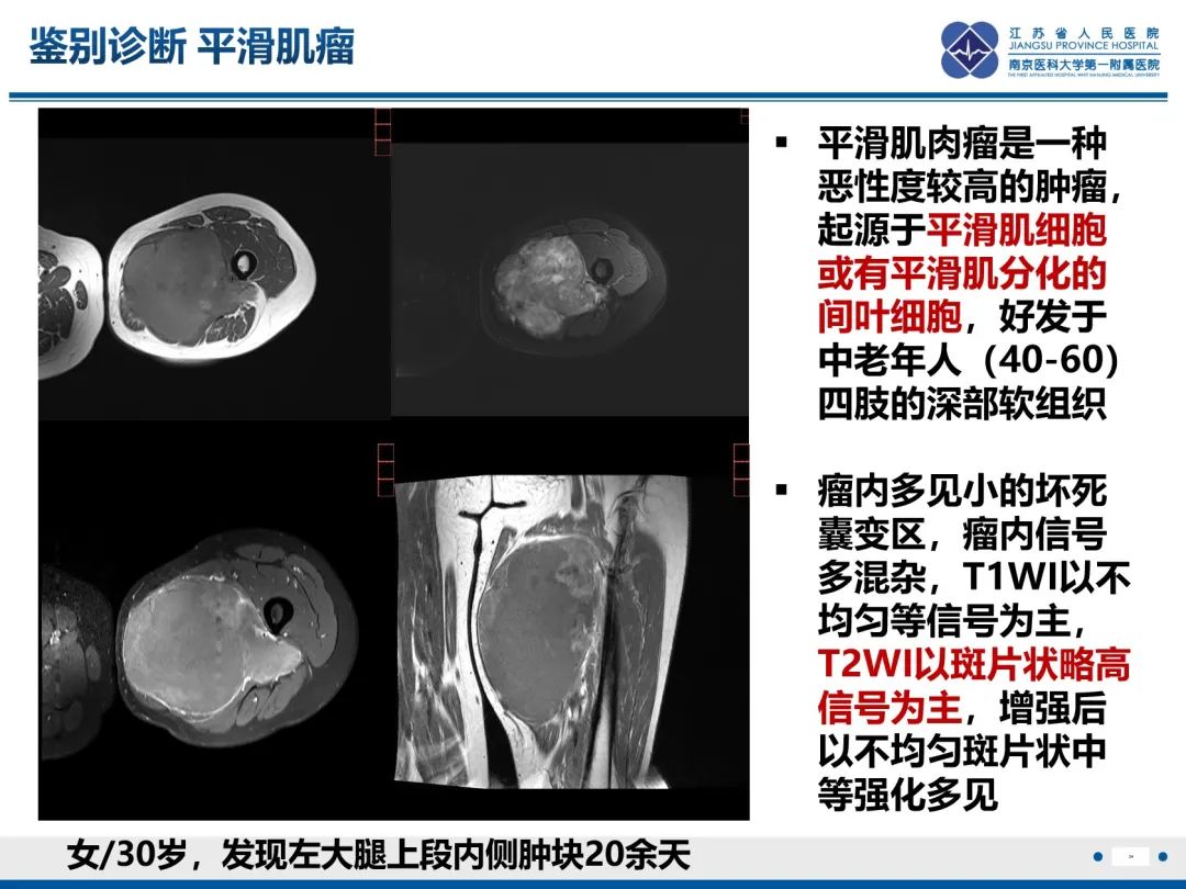 影像PPT - 【PPT】滑膜肉瘤-34