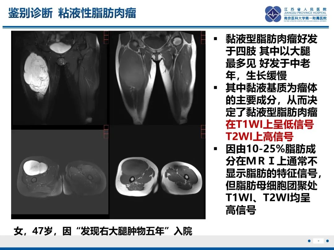 影像PPT - 【PPT】滑膜肉瘤-35