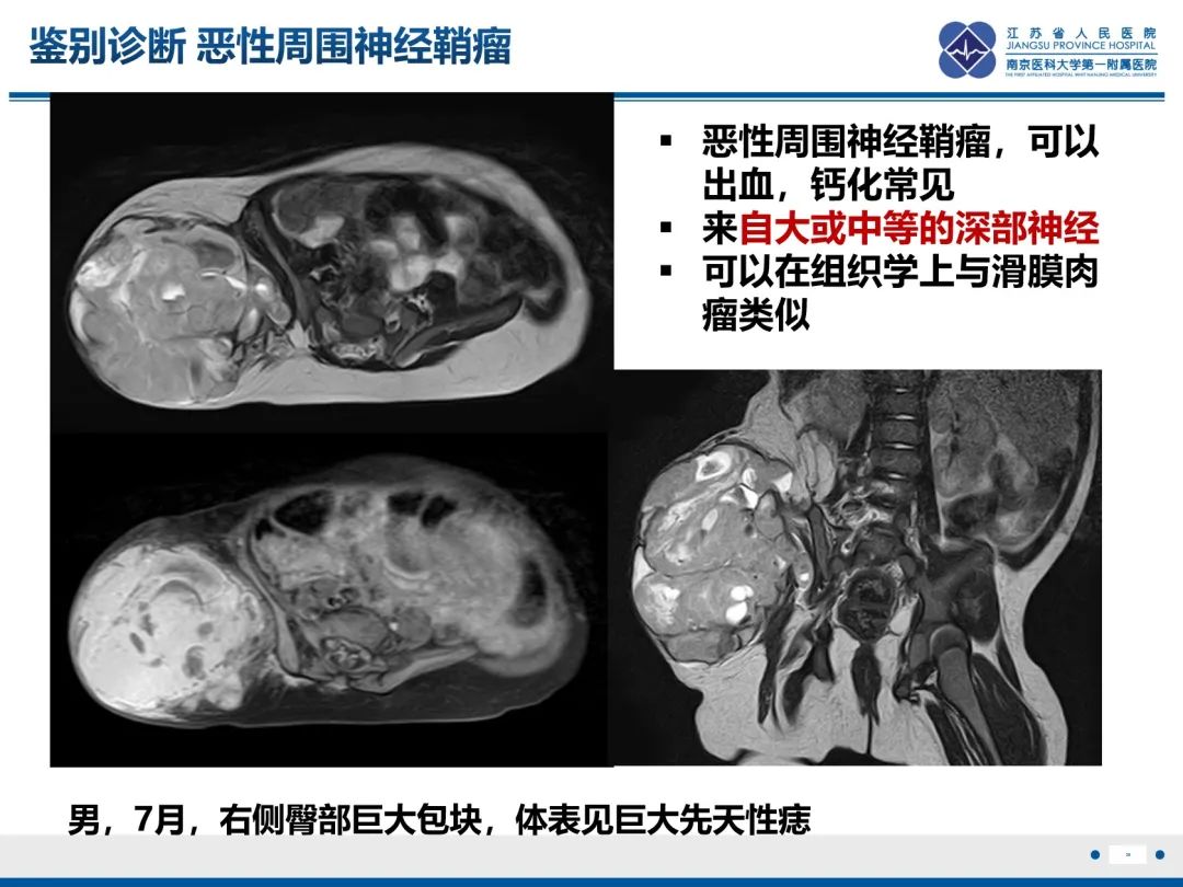 影像PPT - 【PPT】滑膜肉瘤-36
