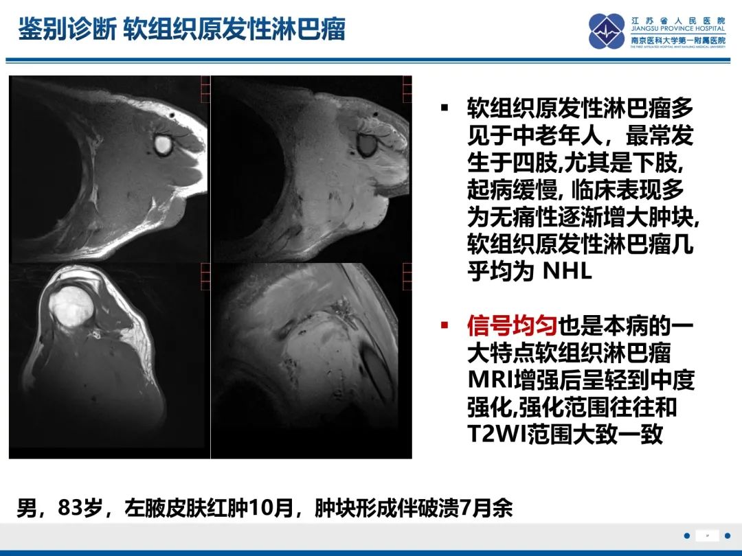 影像PPT - 【PPT】滑膜肉瘤-37