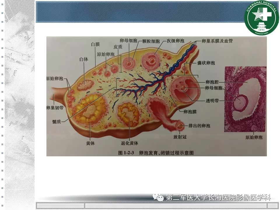 影像PPT - 【PPT】卵巢及其囊性病变-6