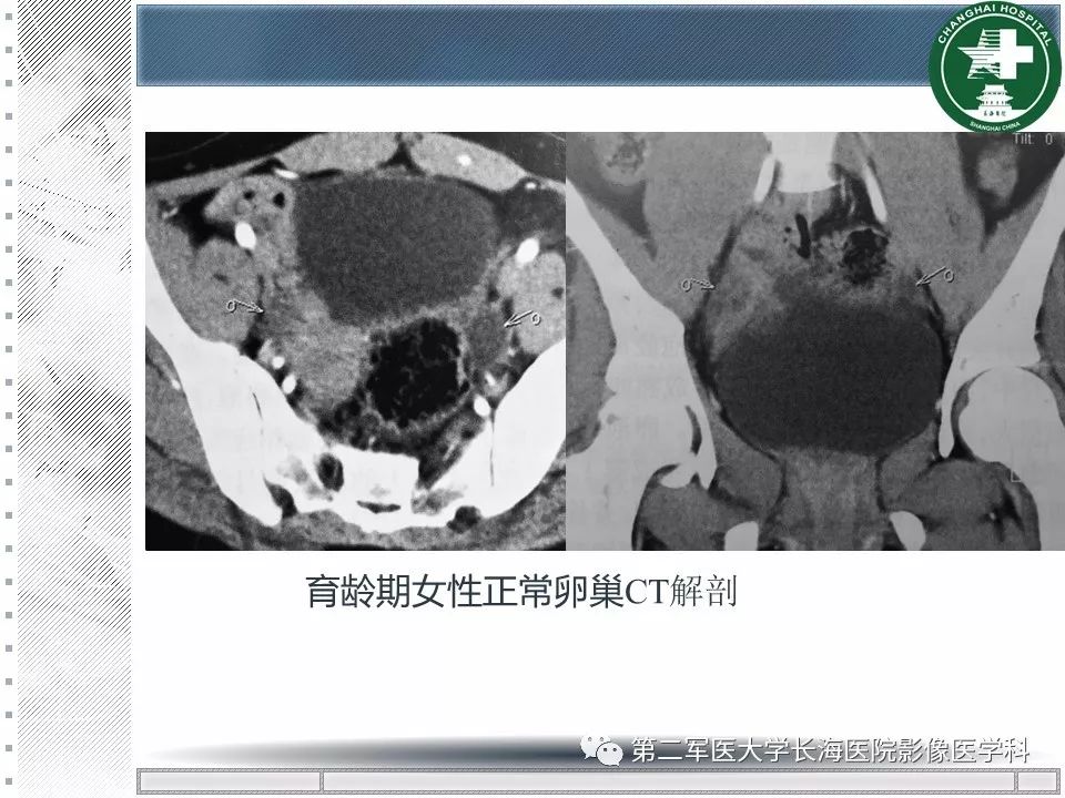 影像PPT - 【PPT】卵巢及其囊性病变-11