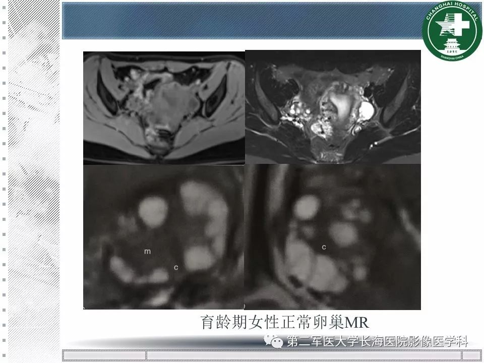 影像PPT - 【PPT】卵巢及其囊性病变-12