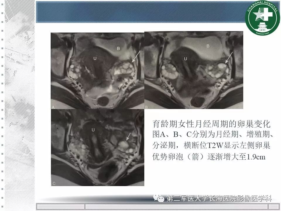 影像PPT - 【PPT】卵巢及其囊性病变-13