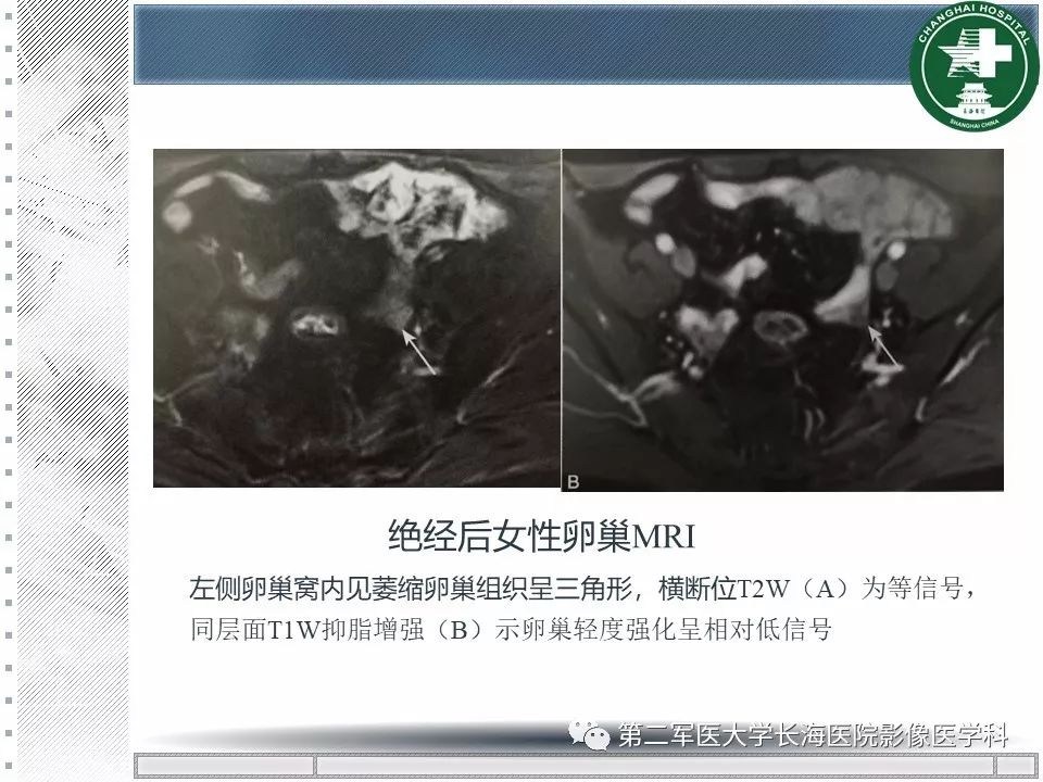 影像PPT - 【PPT】卵巢及其囊性病变-15