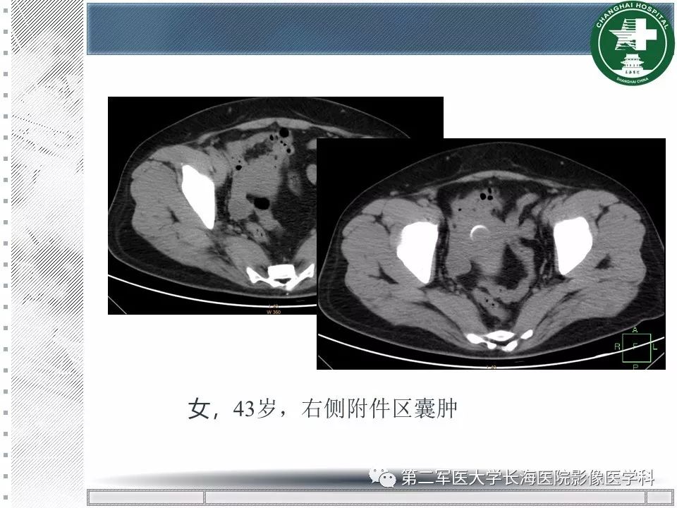 影像PPT - 【PPT】卵巢及其囊性病变-21