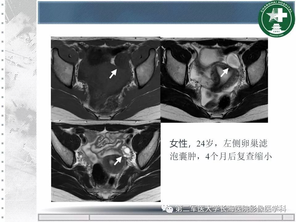 影像PPT - 【PPT】卵巢及其囊性病变-22