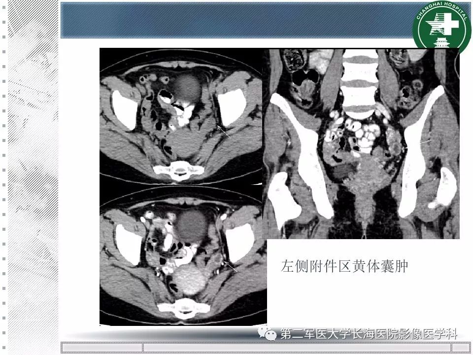 影像PPT - 【PPT】卵巢及其囊性病变-26