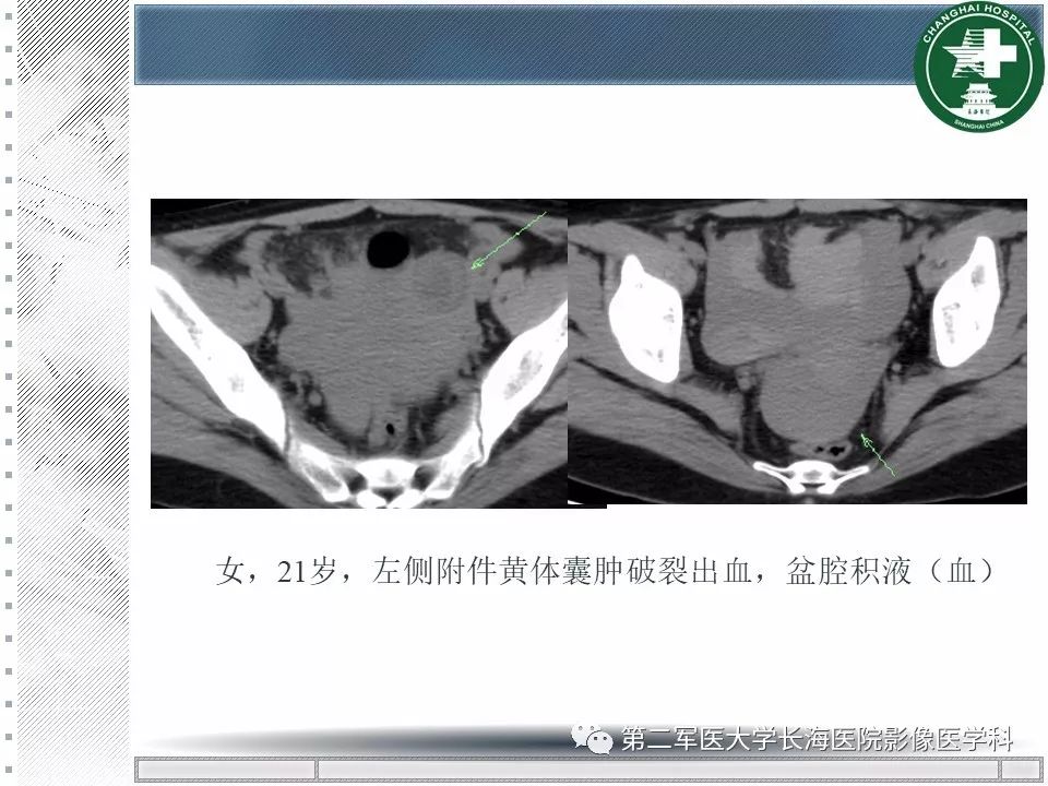影像PPT - 【PPT】卵巢及其囊性病变-27