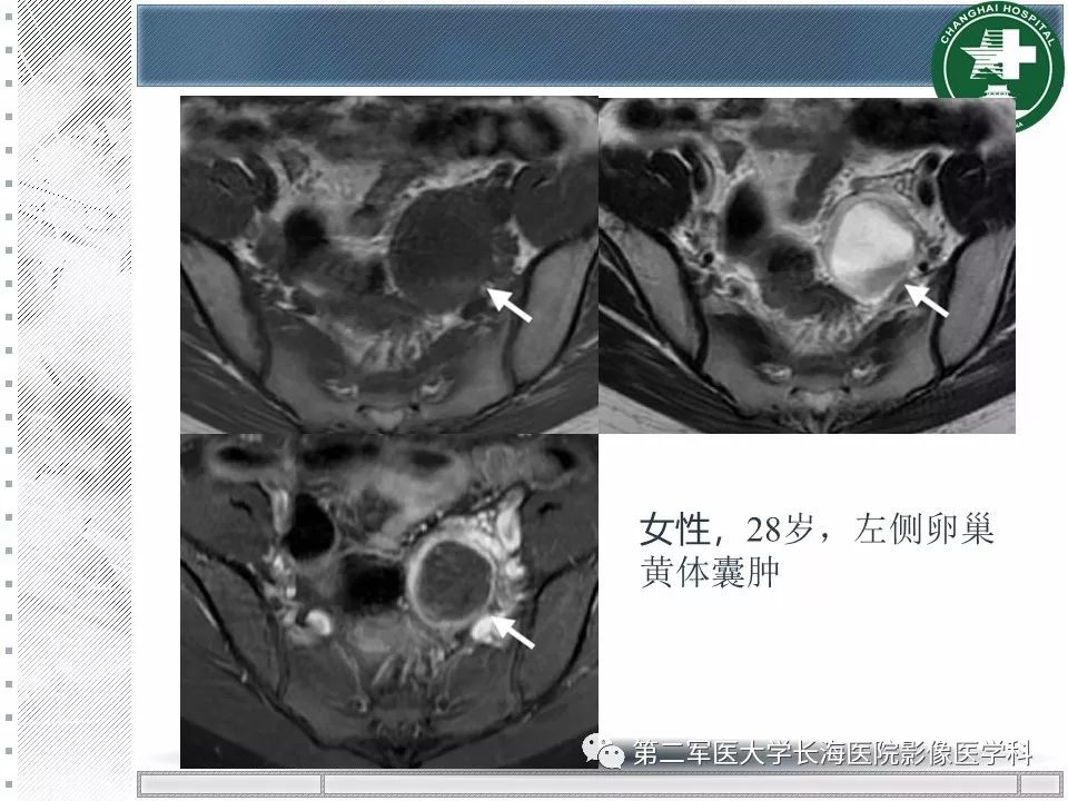 影像PPT - 【PPT】卵巢及其囊性病变-29