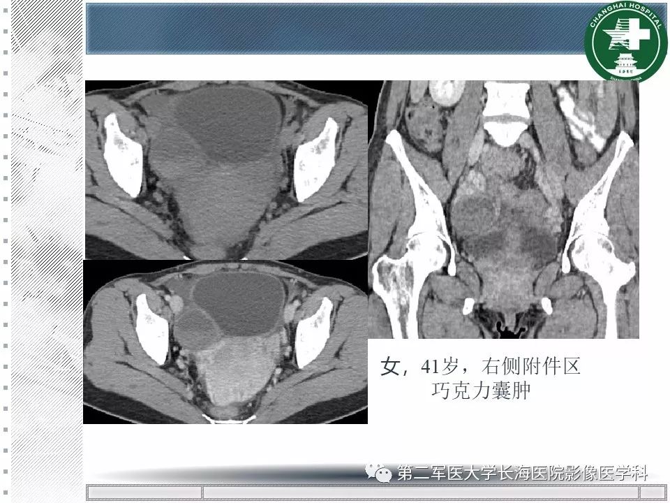 影像PPT - 【PPT】卵巢及其囊性病变-36
