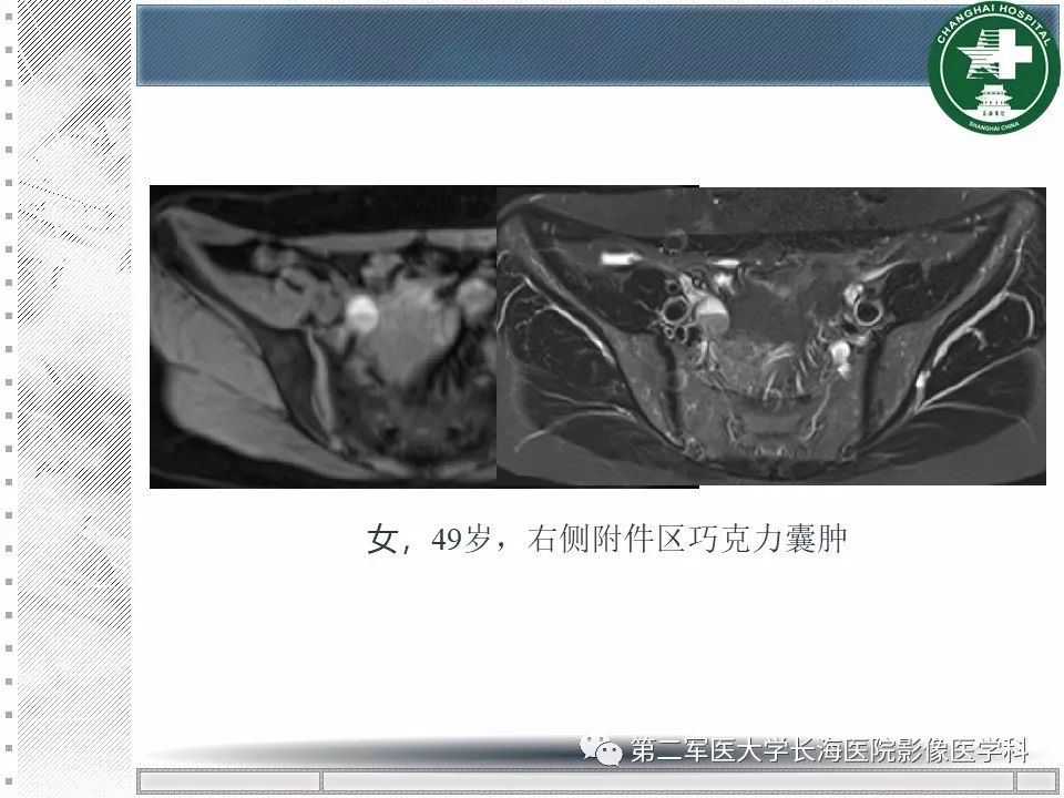 影像PPT - 【PPT】卵巢及其囊性病变-37