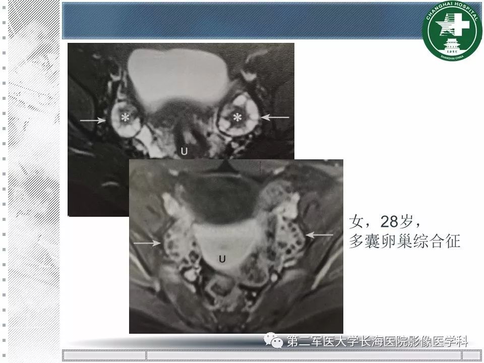 影像PPT - 【PPT】卵巢及其囊性病变-41