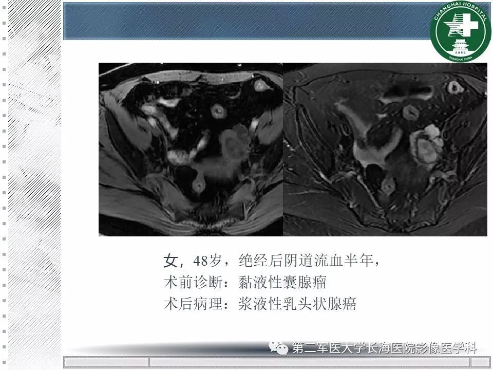 影像PPT - 【PPT】卵巢及其囊性病变-47