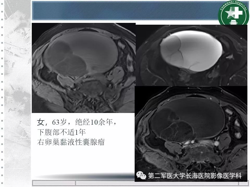 影像PPT - 【PPT】卵巢及其囊性病变-49