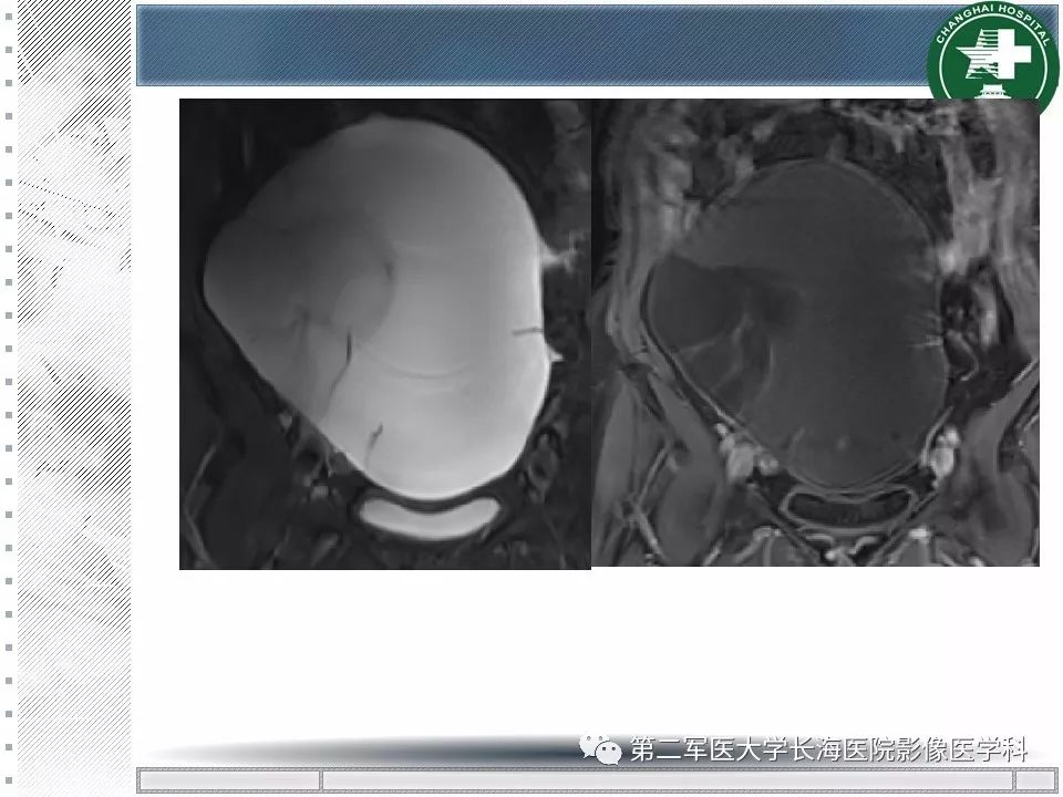影像PPT - 【PPT】卵巢及其囊性病变-50