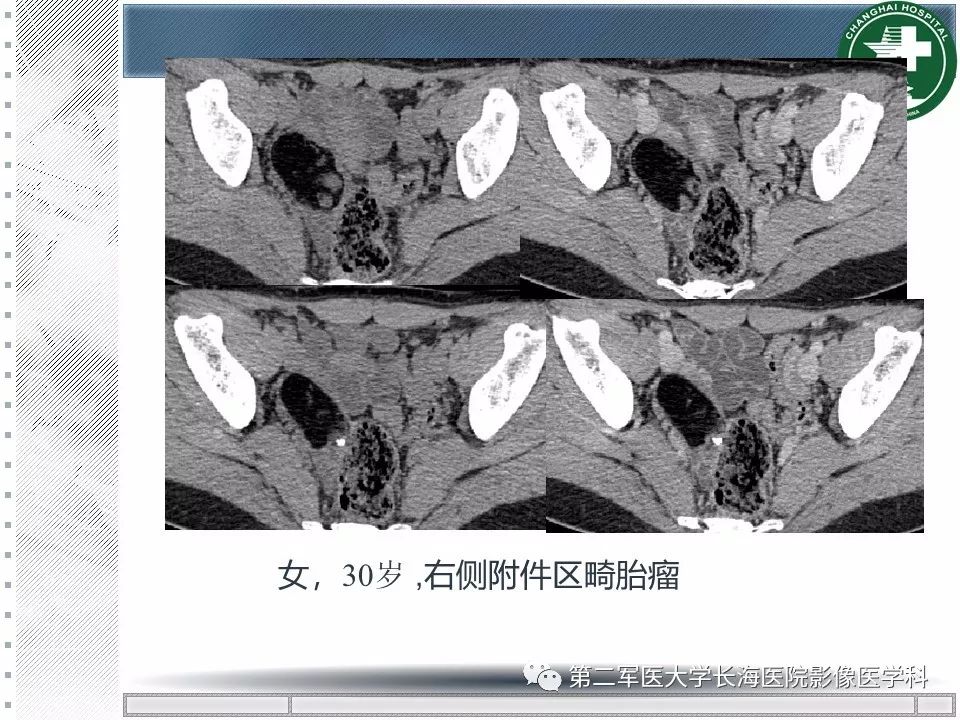 影像PPT - 【PPT】卵巢及其囊性病变-53