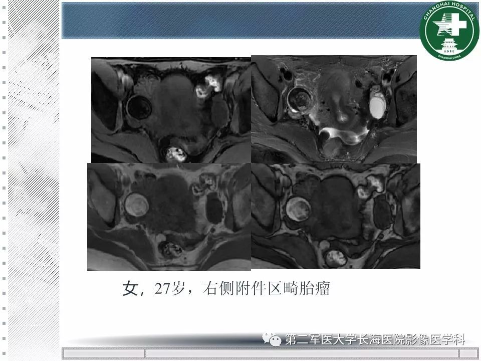 影像PPT - 【PPT】卵巢及其囊性病变-54
