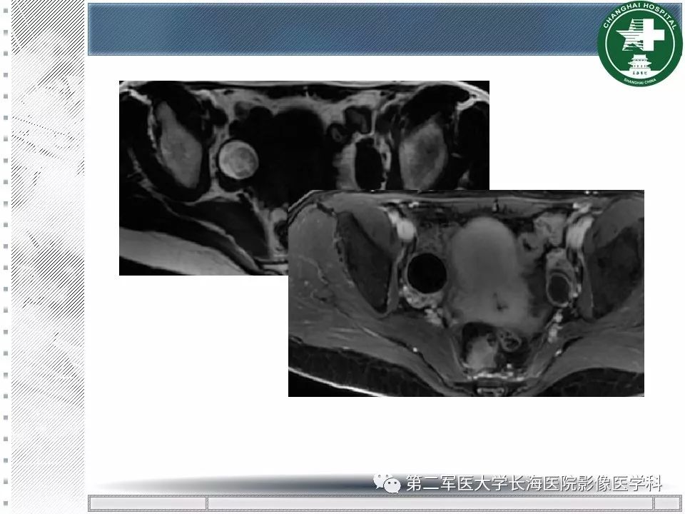 影像PPT - 【PPT】卵巢及其囊性病变-55