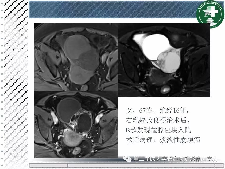 影像PPT - 【PPT】卵巢及其囊性病变-59