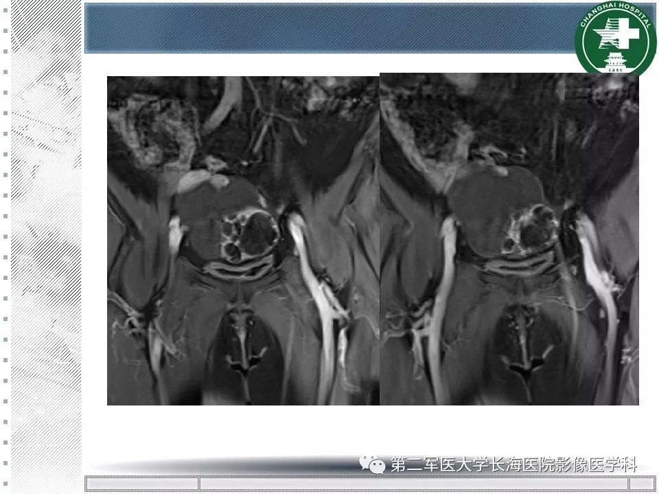 影像PPT - 【PPT】卵巢及其囊性病变-60