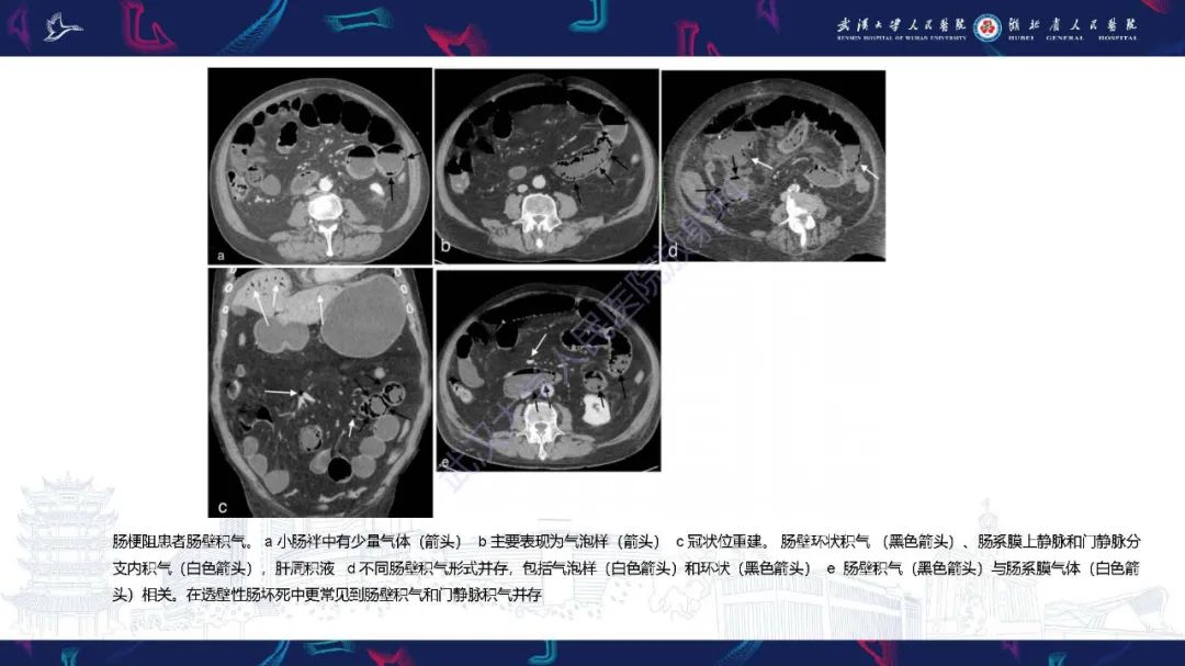 影像PPT - 【PPT】肠壁积气相关疾病影像诊断-19