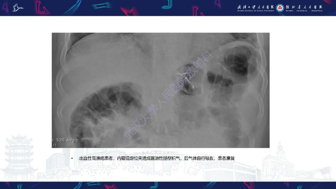 影像PPT - 【PPT】肠壁积气相关疾病影像诊断-24