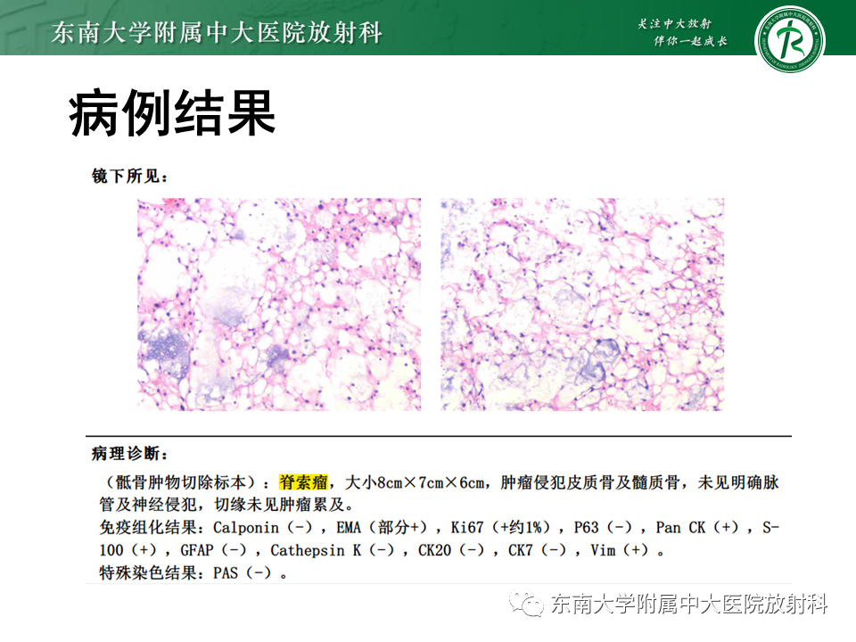影像PPT - 【PPT】脊索瘤的影像-3