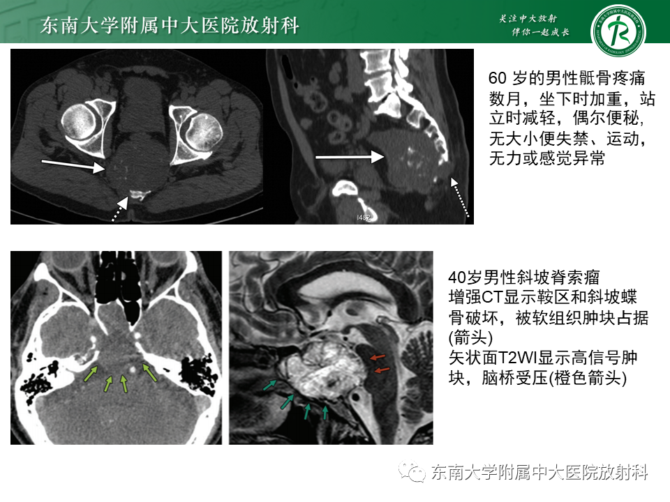 影像PPT - 【PPT】脊索瘤的影像-11