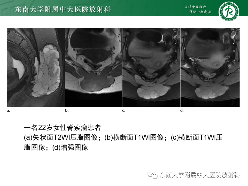 影像PPT - 【PPT】脊索瘤的影像-12