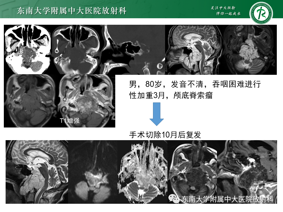 影像PPT - 【PPT】脊索瘤的影像-15
