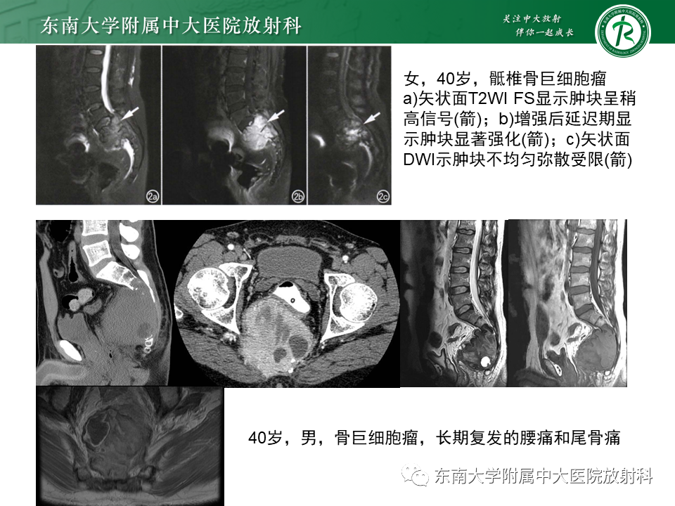 影像PPT - 【PPT】脊索瘤的影像-18