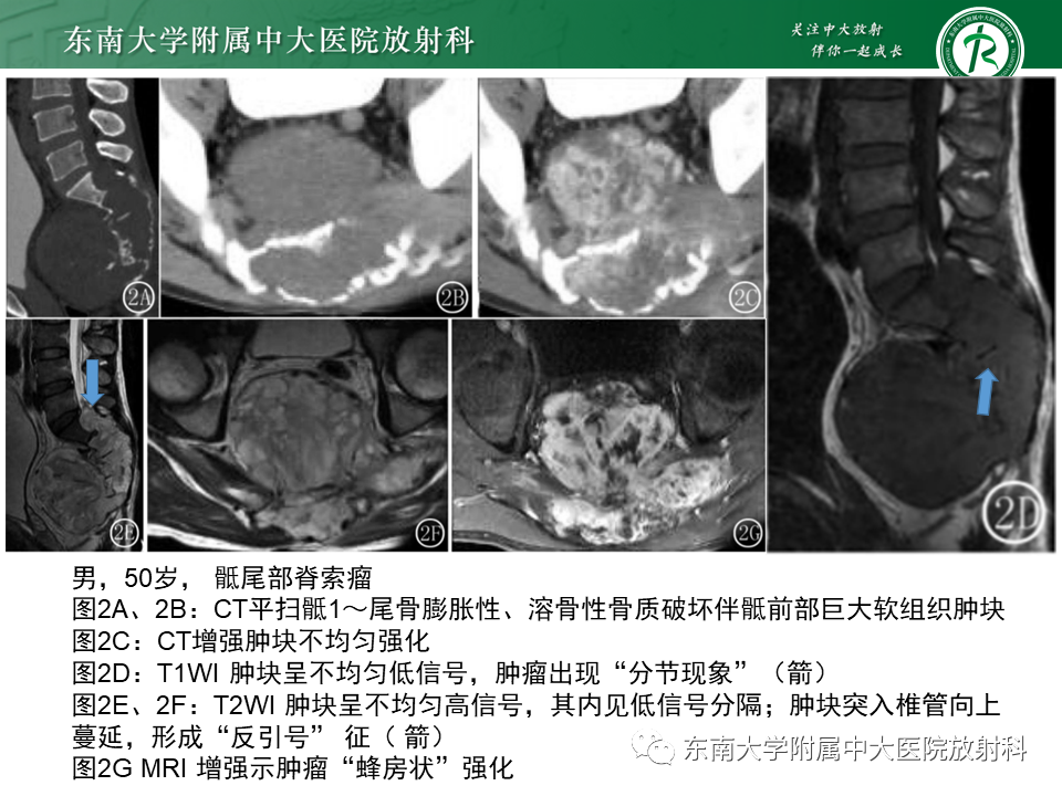 影像PPT - 【PPT】脊索瘤的影像-14
