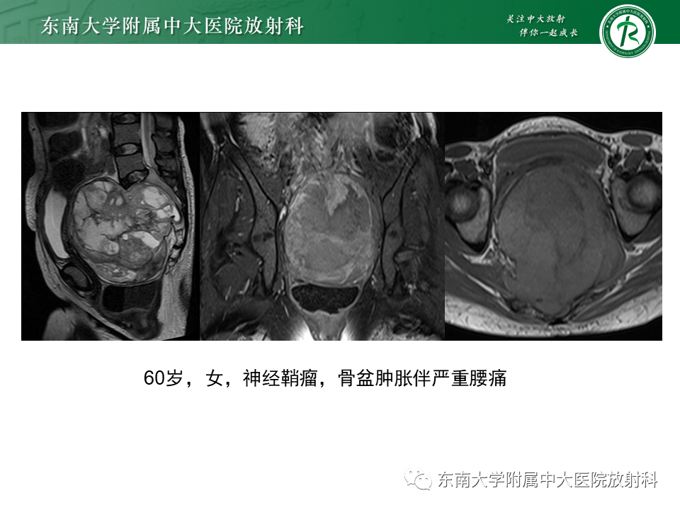 影像PPT - 【PPT】脊索瘤的影像-20