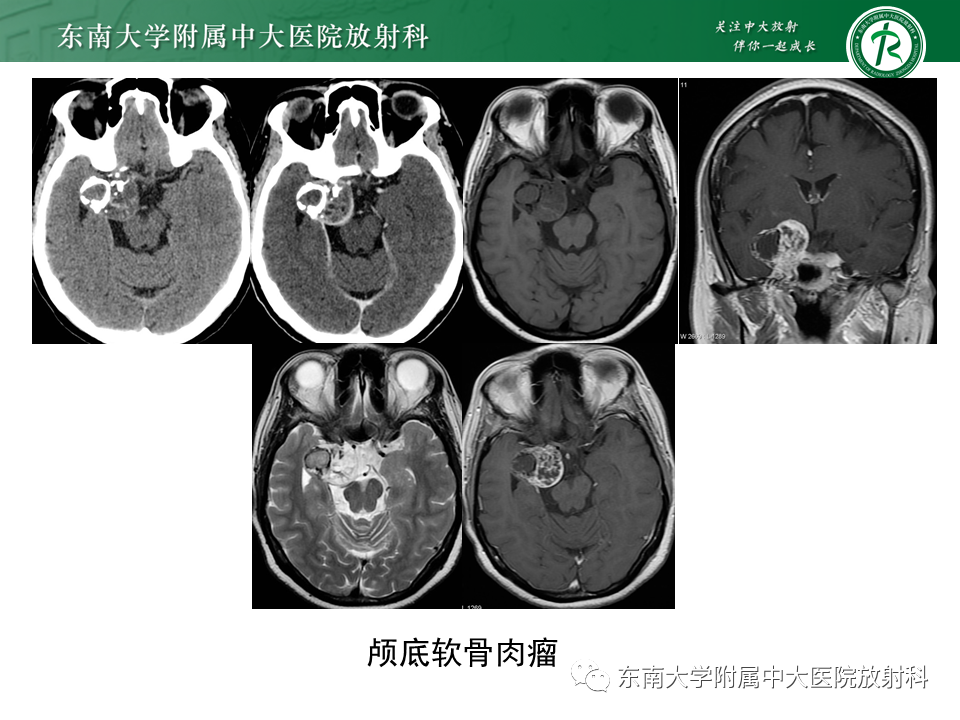 影像PPT - 【PPT】脊索瘤的影像-23