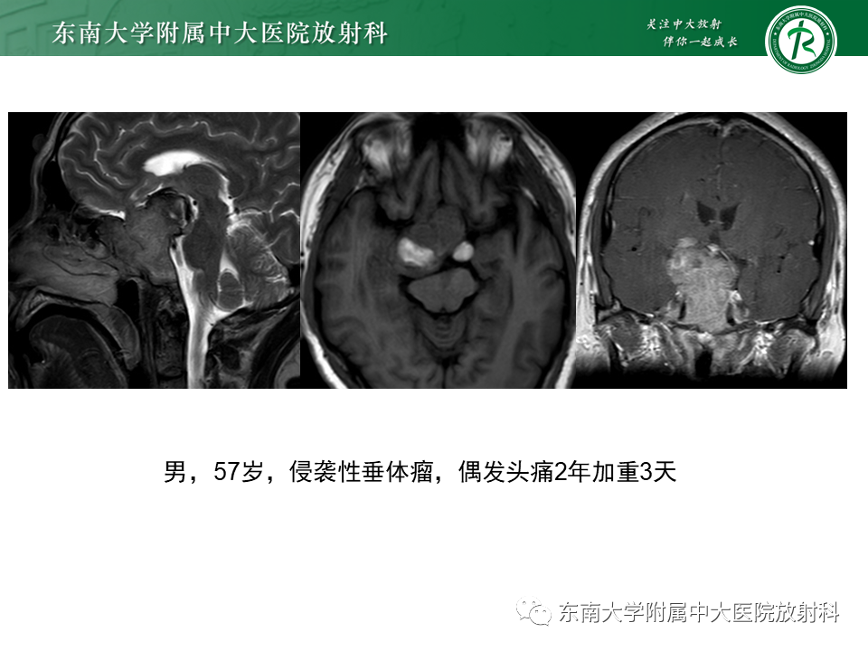 影像PPT - 【PPT】脊索瘤的影像-25
