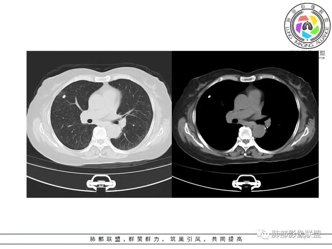 影像PPT - 【病例】披着羊皮的狼—肺炎型肺癌-6 影像PPT - 【病例】披着羊皮的狼—肺炎型肺癌-6
