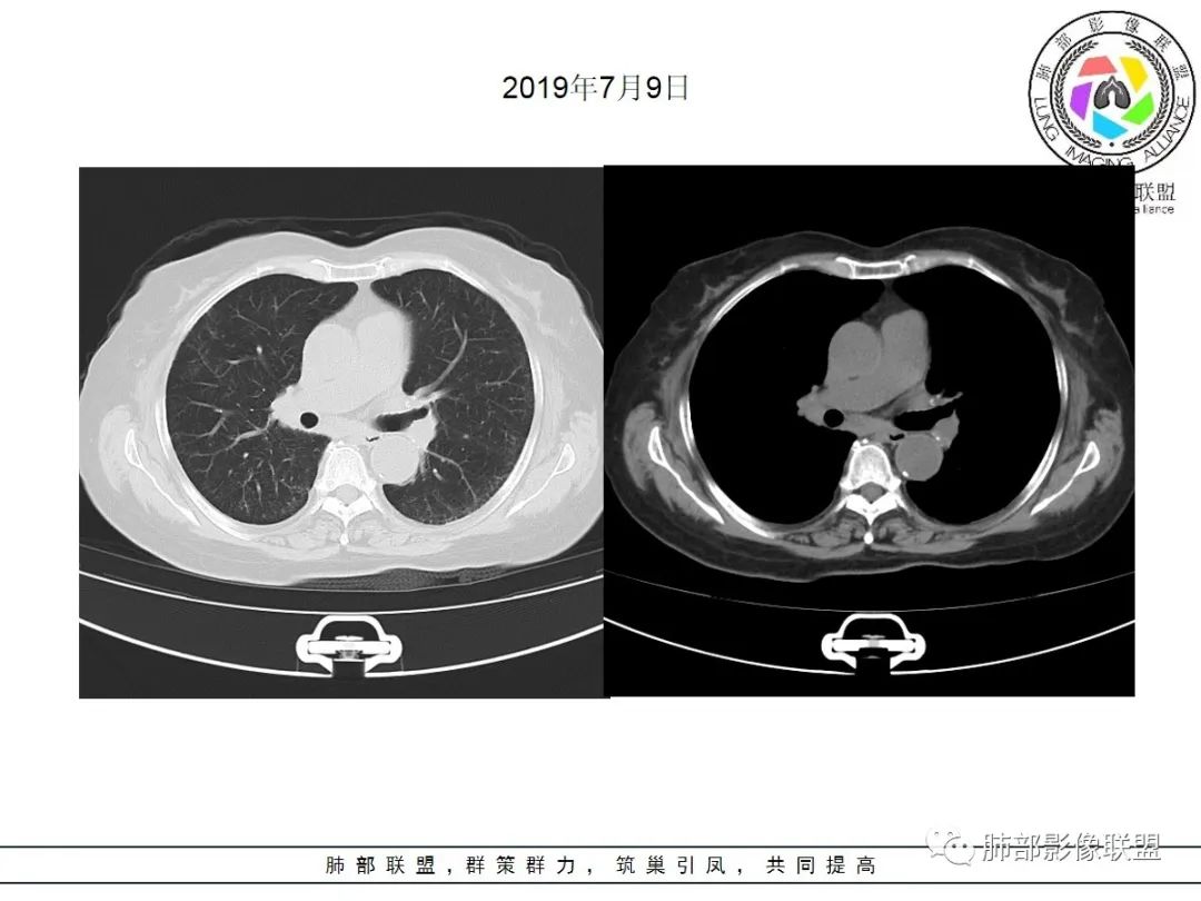 影像PPT - 【病例】披着羊皮的狼—肺炎型肺癌-5 影像PPT - 【病例】披着羊皮的狼—肺炎型肺癌-5