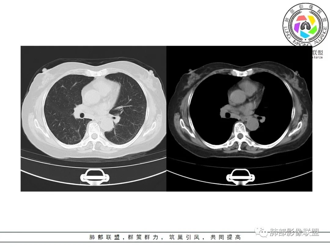 影像PPT - 【病例】披着羊皮的狼—肺炎型肺癌-8 影像PPT - 【病例】披着羊皮的狼—肺炎型肺癌-8